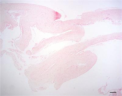 Biopsy and histologic findings of the dura mater at the level of the foramen magnum in 121 CKCS with Chiari-like malformation